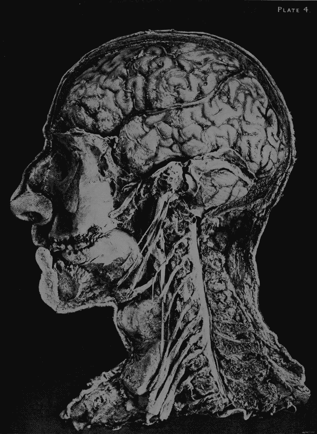 A photograph from A Guide to Operations on the Brain by Alec Fraser – 1890